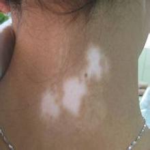 cxvcbf.jpg 白癜风症状