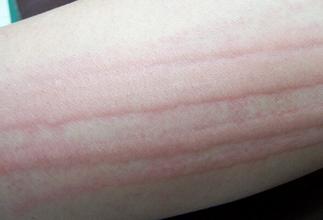 ݡ�����֢״����ô����