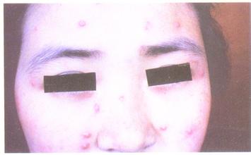 毛囊炎怎么引起的