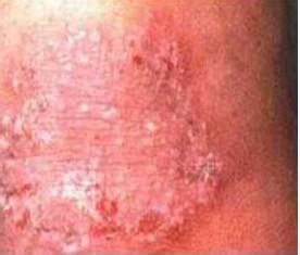 体癣是怎么形成的