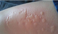 汕头脸皮肤过敏治疗方法